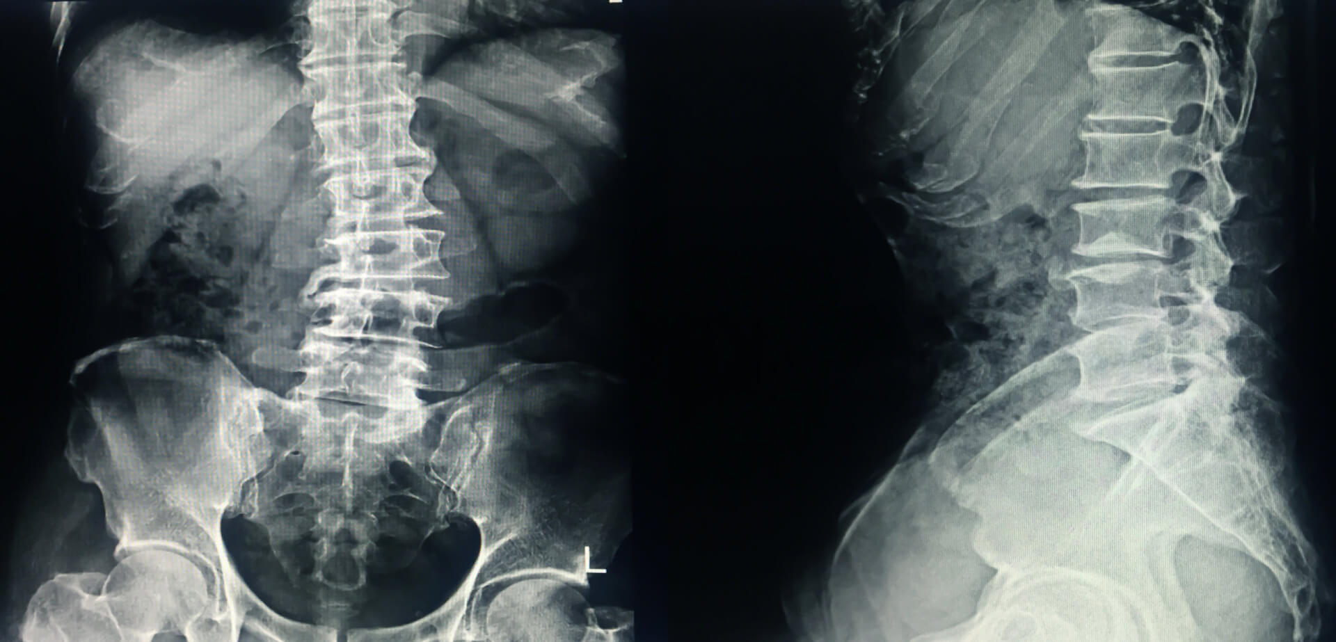 Radiografía frontal y lateral de una columna vertebral aquejada de escoliosis. 
